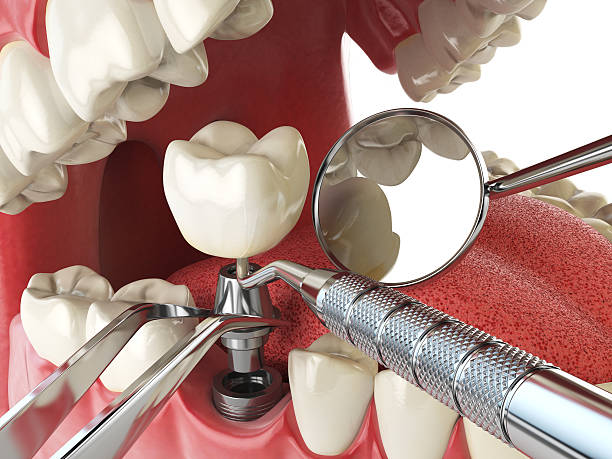 Best Emergency Denture Repair in Mattawan, MI